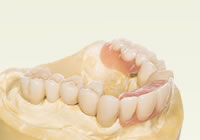 コーヌス テレスコープ義歯